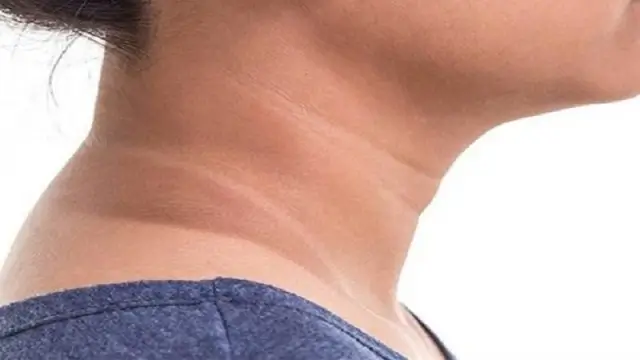 مقاومة الانسولين